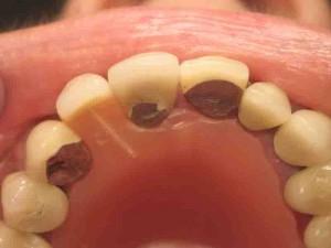 Denture for a single tooth