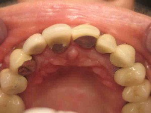 Single tooth implant